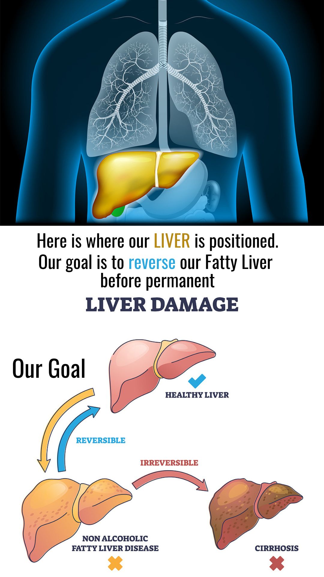 Illustration where the liver is located and flow chart of reversing fatty liver or it becoming permanently damaged