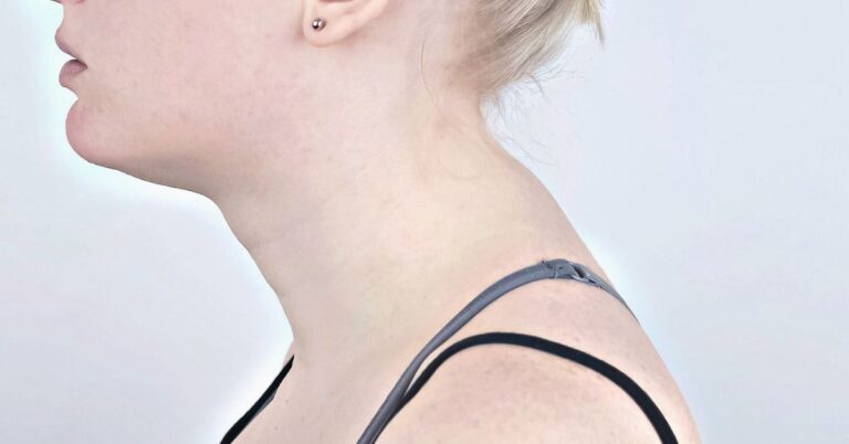Side view ofthe neck and lower head region of a woman showing a neck hump also called a dowager's hump