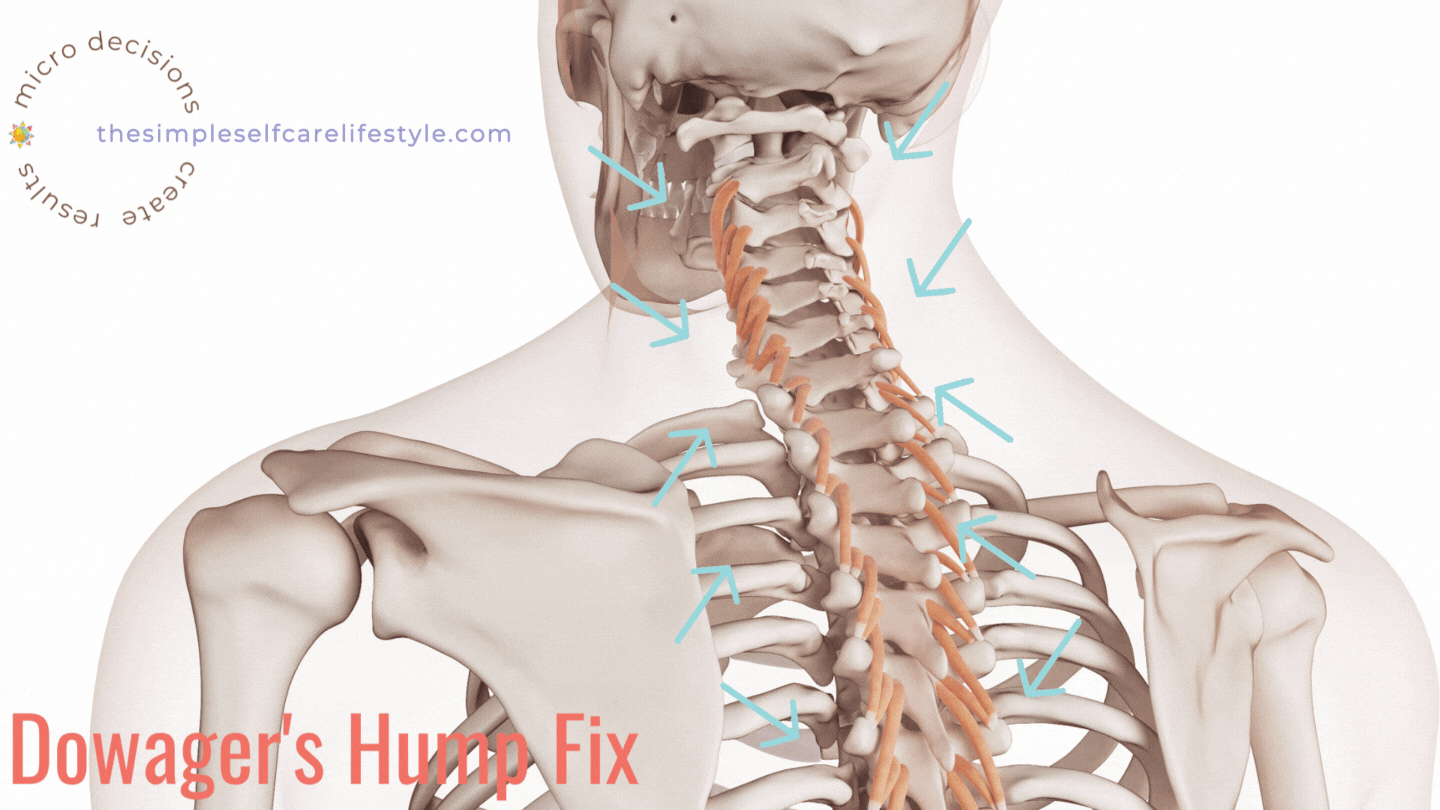 Neck Hump also called dowagers hump. Arrows pointing to the little spinal muscles