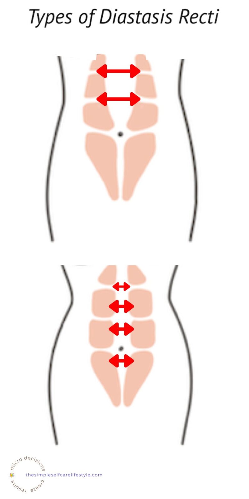 Ab Separation Check & FIX + 1 Popular Exercise to AVOID