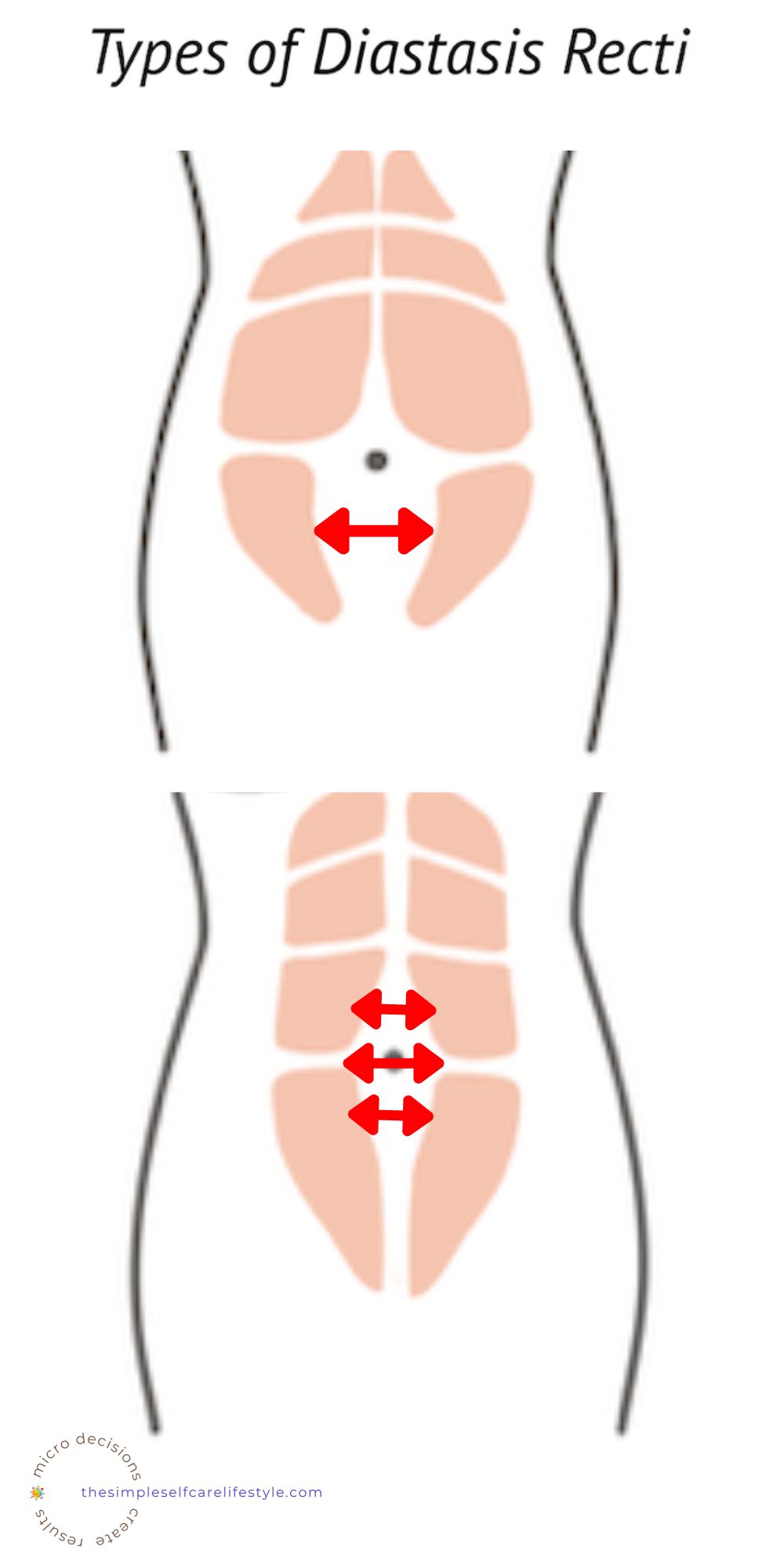 ab separation illustrations of below belly button and around it