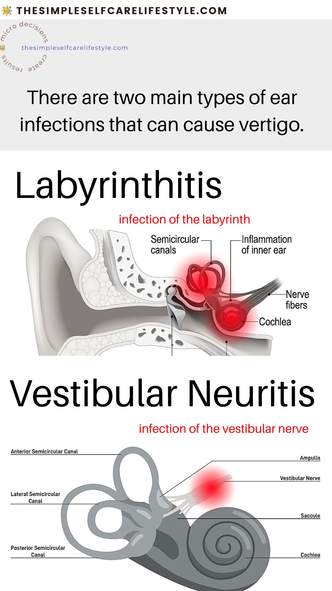 what helps for vertigo is seeing and understanding the parts of the inner ear that can be infected