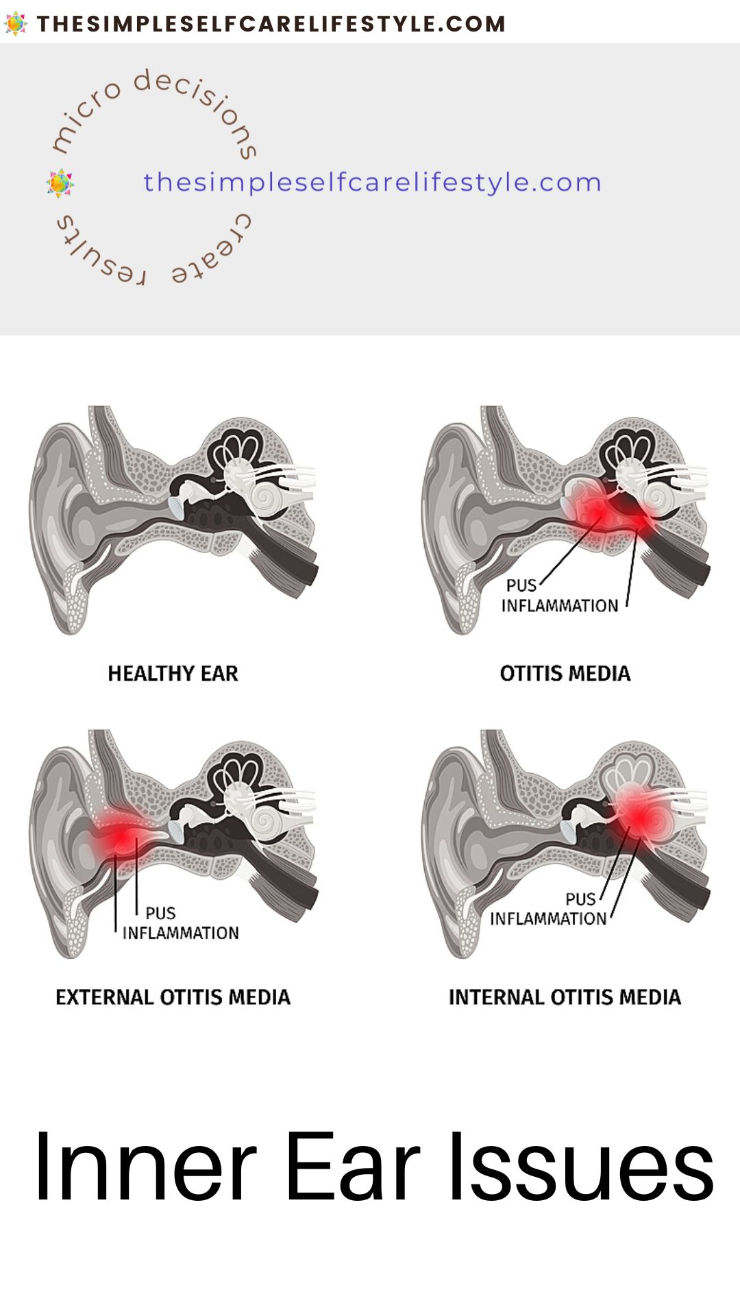 what helps for vertigo can be helped by knowing inner ear issues here are photos of cross section of ear canal. 4 Different illustrations Each with red circle showing where the infection and inflammation that can cause Vertigo is. This info helps 